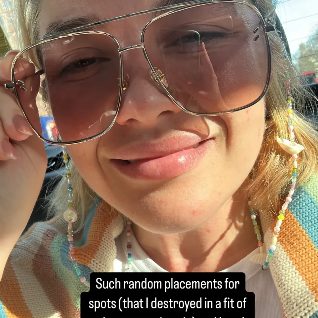 Florence Pugh’s Pimple-Picking Confession Will Make You Feel Seen (And a Little Guilty) 1 Florence Pugh squints behind sunglasses, joking about her pimple-picking habit on Instagram Stories.